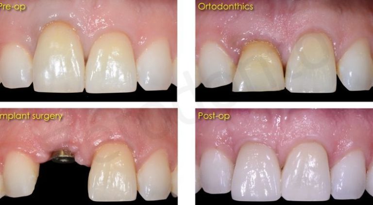 Traitement multidisciplinaire complexe dans le domaine esthétique : de la préparation orthodontique à la finalisation implanto-prothétique